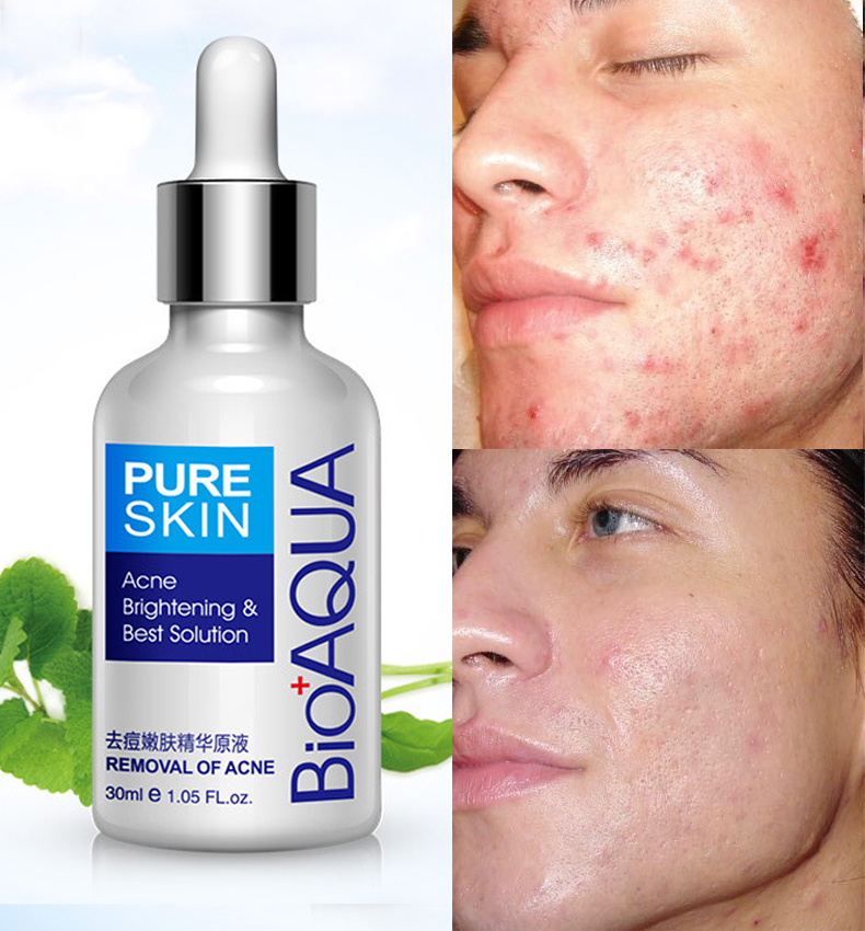 سرم ضد جوش BIOAQUA Removal of Acne برای مراقبت از پوست مستعد جوش و کمک به صاف‌تر دیده شدن پوست